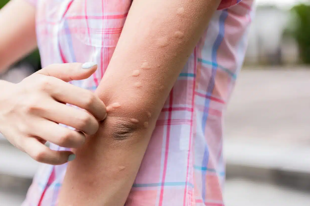 De quoi est composée une crème anti-piqûre d’insecte.